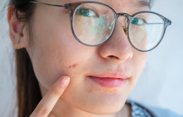 Acne-shaming is alive and well in the workplace. (Photo: Boy_Anupong via Getty Images)