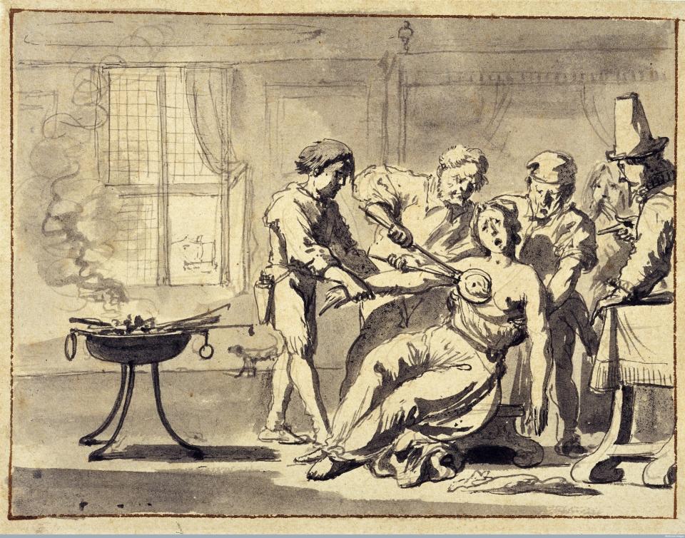 The operator excises the breast with the "tenaculum helvetianum." His assistant has a case of lancets etc. attached to his belt. A set of cautery irons is smoldering on a stand on the left. The patient is seated, held by two men: She appears to be fainting. On the right, a man in a tall hat points toward her: He is possibly meant to be a physician. (Drawing 1600-1699) 
