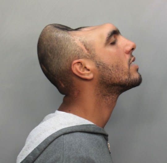 This insane "Half Head Man" mugshot went viral in 2012 after this man, who allegedly went by "Halfy" was charged with soliciting prostitution. <a href="http://www.huffingtonpost.com/2012/02/15/half-head-man-from-famous_n_1279337.html" target="_blank">His flattened skull came, he said, from a car accident he got into while on drugs.</a> "I was driving, and I hit a pole, and I flew out the front window and landed on my head," he told The Miami New Times. 