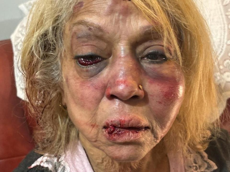 Ninette Simons suffered severe facial bruising and swelling. Picture: WA Police/Supplied