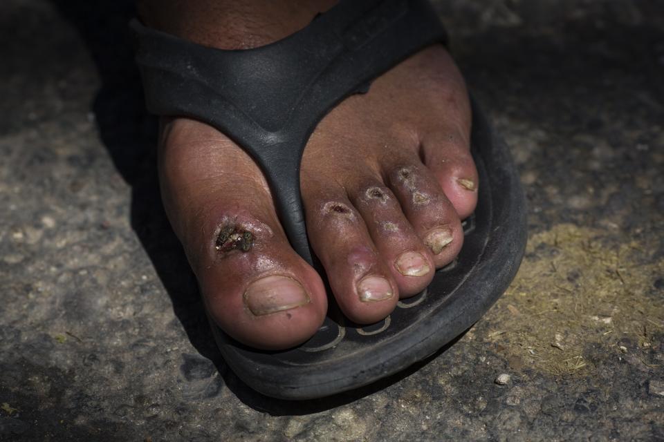 In this Oct. 31, 2018 photo, flies cover one of the blisters on Honduran migrant Gerson Noel Rivas' toes as the U.S.-bound Central American migrant caravan makes a stop in Juchitan, Mexico, after a day of walking. Three weeks of pounding the hot asphalt of highways every day takes a toll, especially for those plodding along in flimsy flip flops. (AP Photo/Rodrigo Abd)