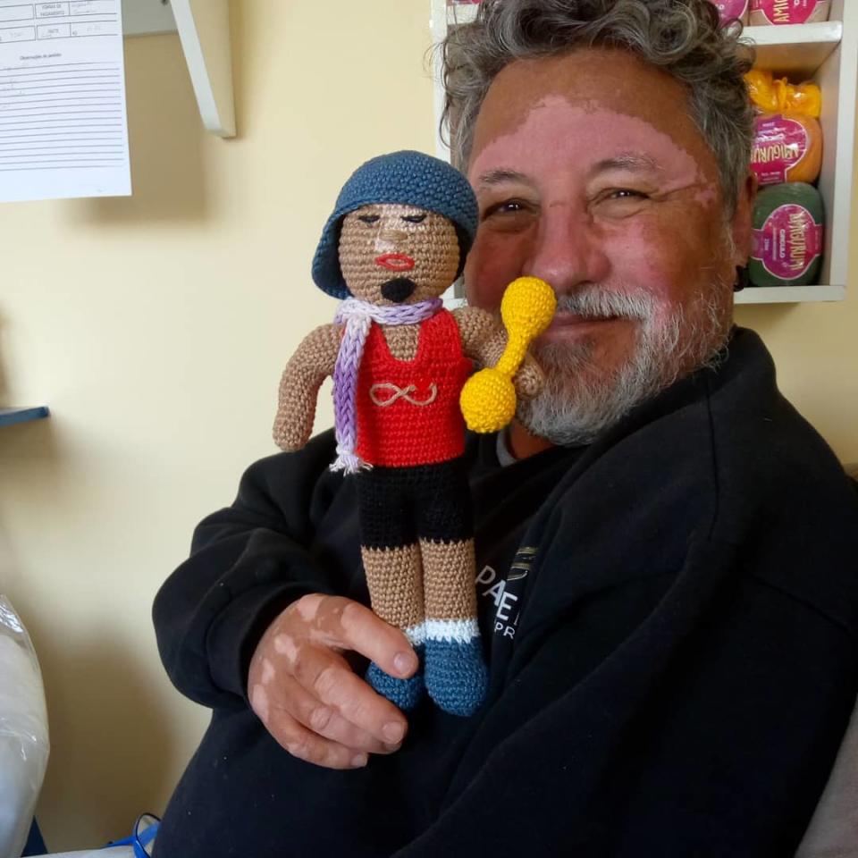 Este hombre crea muñecas con vitíligo para apoyar a niños que sufren esta enfermedad
