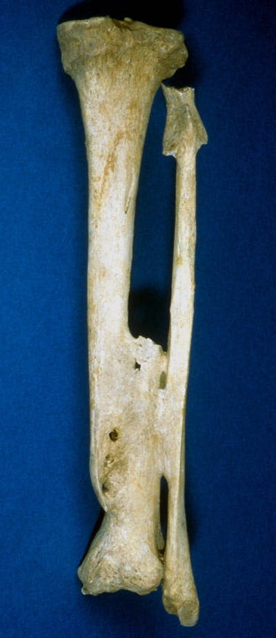 A healed fracture of the lower leg bones from a person buried in Roman Winchester, England. Charlotte Roberts, <a href="http://creativecommons.org/licenses/by-nd/4.0/" rel="nofollow noopener" target="_blank" data-ylk="slk:CC BY-ND;elm:context_link;itc:0;sec:content-canvas" class="link ">CC BY-ND</a>