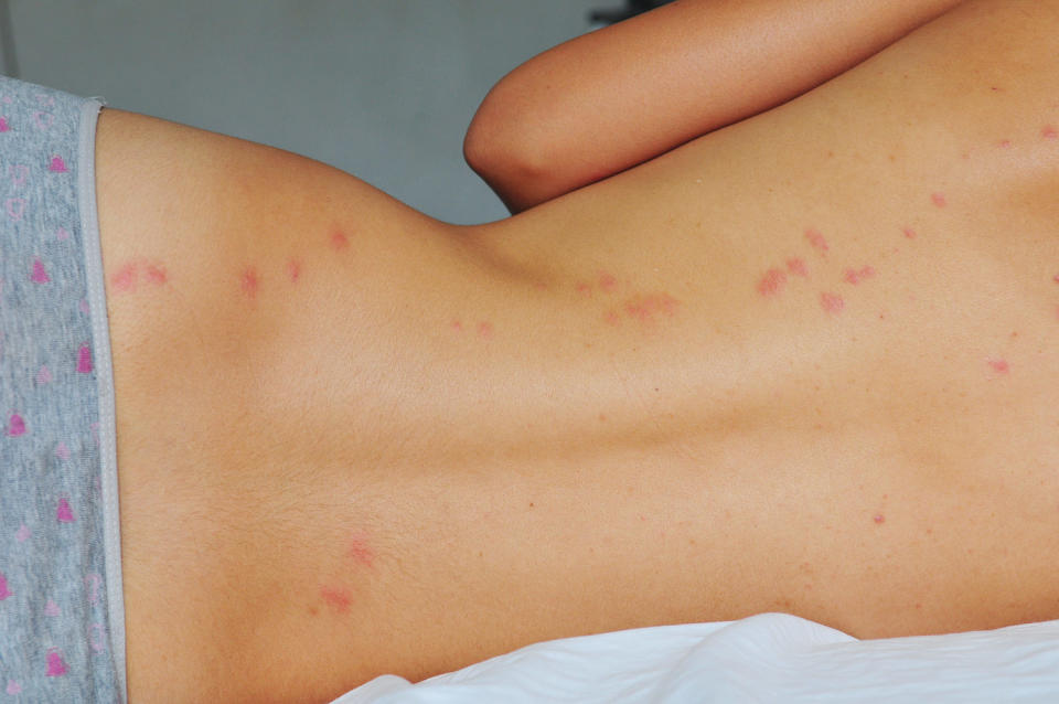 Bed bug Bites pictures (Joel Carillet / Getty Images)