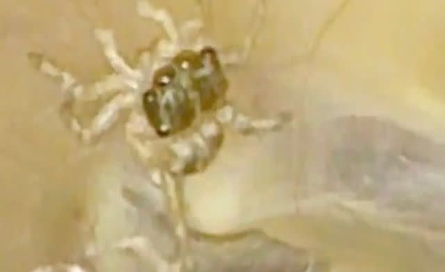 <p>New England Journal of Medicine</p> The spider found in a woman's ear.