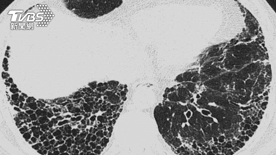 新冠後遺症恐釀肺損傷、肺纖維化。（圖／院方提供）