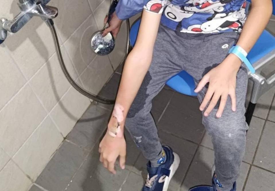 10歲男童手腕戴著智慧手錶炸到面目全非，他的右手臂2度燒燙傷。民眾提供