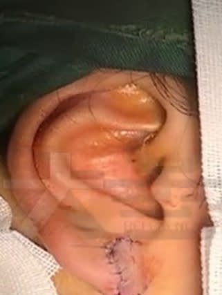 女子耳朵留下個大疤。（圖／翻攝自河南廣播電視台頻道「大參考」微博）