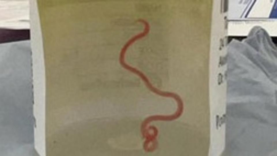 8cm worm pulled from canberra woman's brain