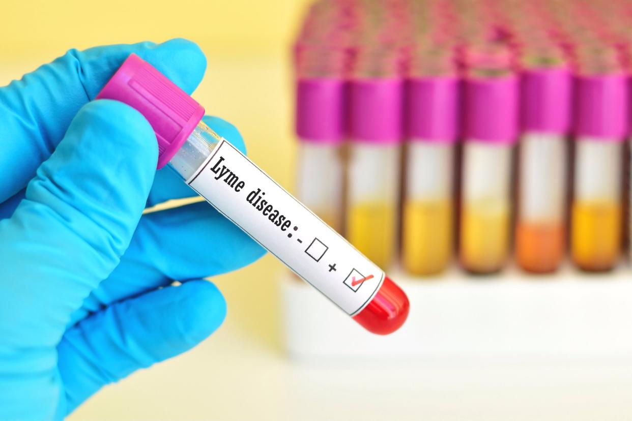 Blood sample positive with Lyme disease