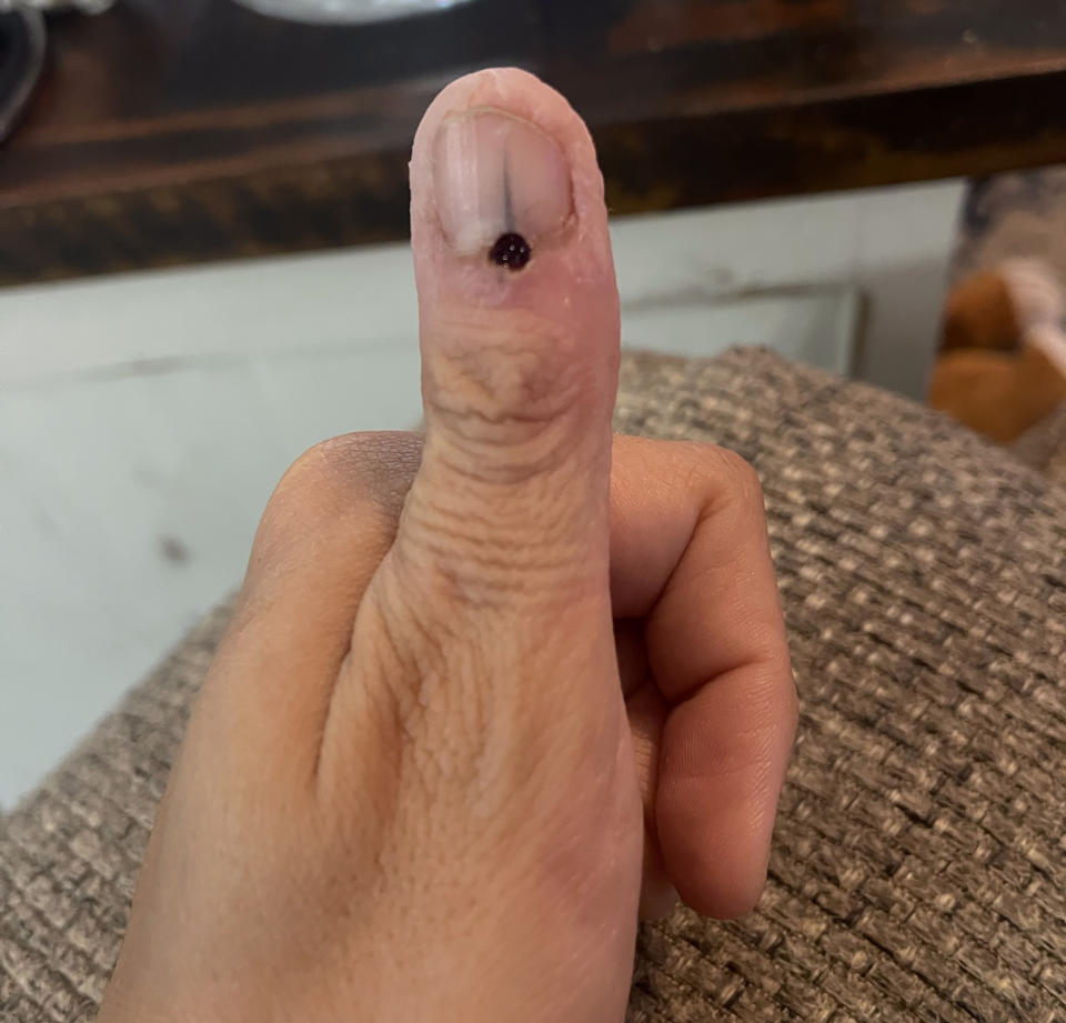 Taking frequent pictures of her nail helped Charmaine Sherlock receive a correct diagnosis of what was growing in her nail. (Courtesy Charmaine Sherlock)