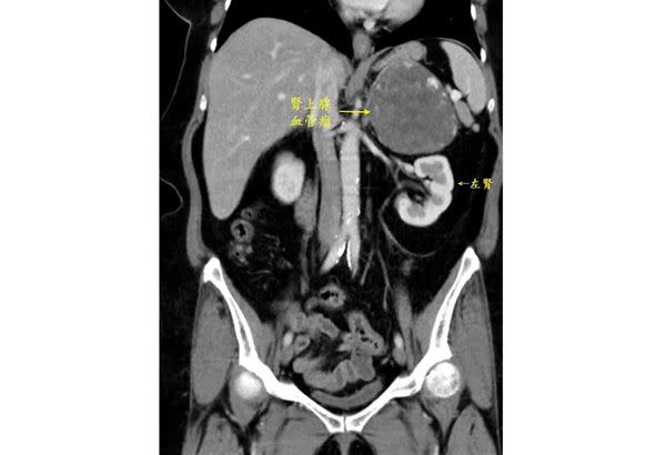 腎上腺血管瘤。（圖片提供／台北慈濟醫院）