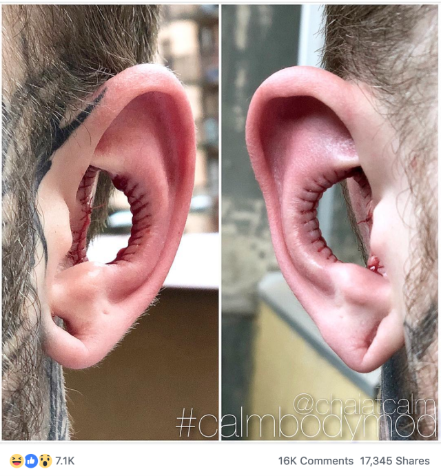 A Man Had Part of His Ear Cut Out in a Controversial “Conch Removal