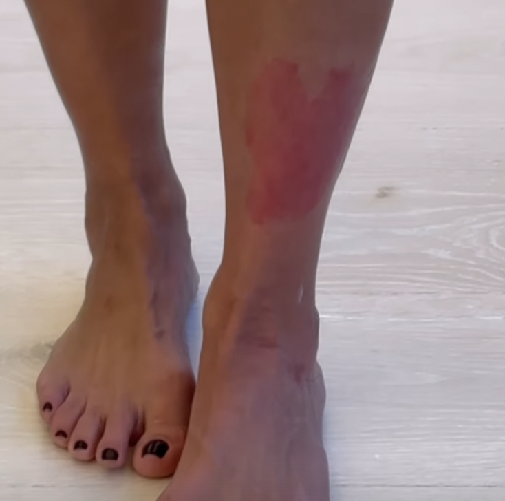 kim kardashian reveals painful psoriasis on leg