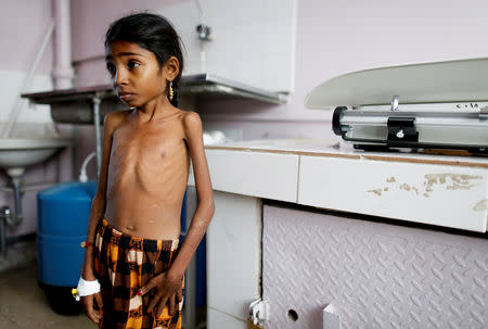 Afaf Hussein, 10, who is malnourished, waits to be weighed at the malnutrition treatment ward of al-Sabeen hospital in Sanaa, Yemen, February 3, 2019. Afaf, who now weighs around 11 kg and is described by her doctor as "skin and bones", has been left acutely malnourished by a limited diet during her growing years and suffering from hepatitis, likely caused by infected water. She left school two years ago because she got too weak. REUTERS/Khaled Abdullah