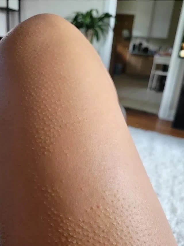 A person's thigh with goosebumps except for one flat area