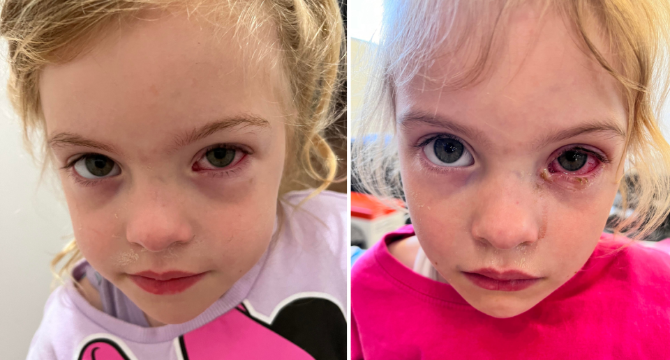 Perth girl Abigail showing her injured eye from playground sand