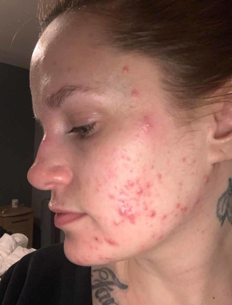 Kerrie has suffered with angry acne, pictured at its worst in early summer 2020, since she was 14. PA REAL LIFE/ COLLECT