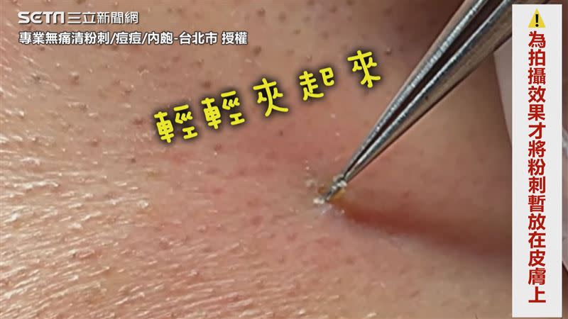 最後輕輕勾拉數回合終於拔起。（圖／專業無痛清粉刺/痘痘/內皰-台北市 授權）