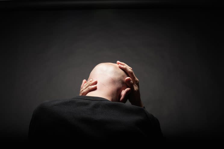 A young Singaporean man tells his story of living with alopecia (Photo: Getty Images)