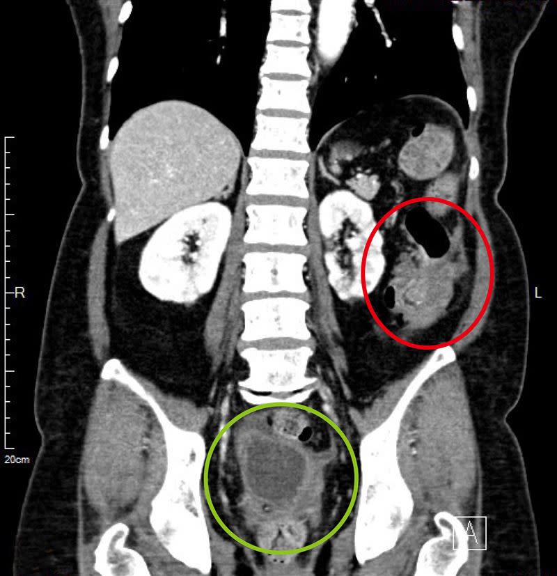 患者腫瘤造成大腸套疊，紅圈處為大腸癌，綠圈處為骨盆腔腹膜黏液性腫瘤。（圖／馬偕醫院提供）