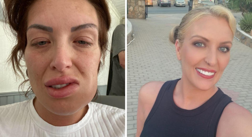 Amanda Turner, pictured left after treatment at the cowboy clinic in Turkey, and right, pictured more recently after having remedial work in the UK. (Supplied)