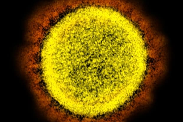 An electron microscope image made available by the U.S. National Institute of Allergy and Infectious Diseases shows a coronavirus particle. (NIAID/NIH via AP - image credit)