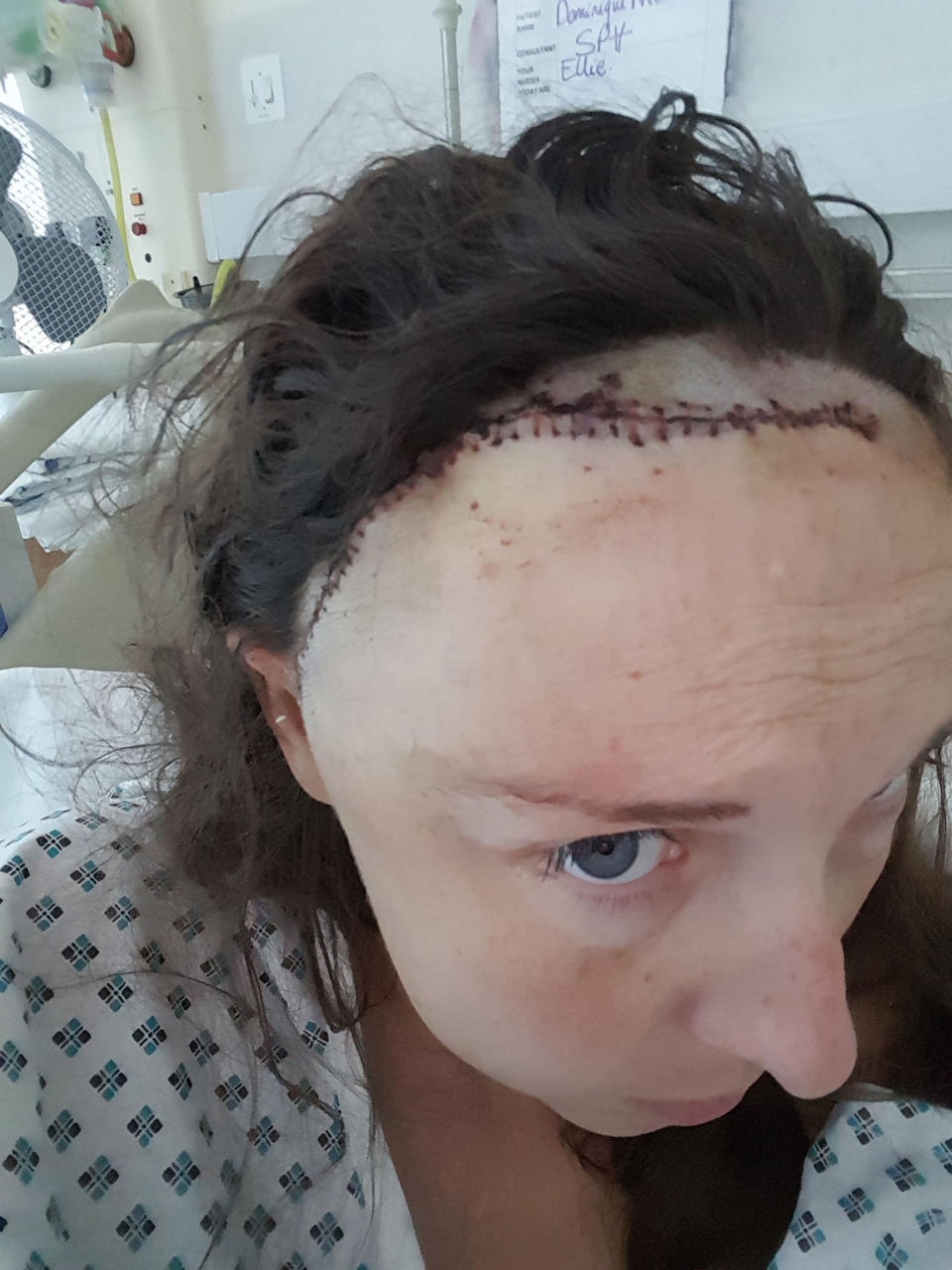 Nicholson was left with a 21cm scar following her surgery. (Caters)