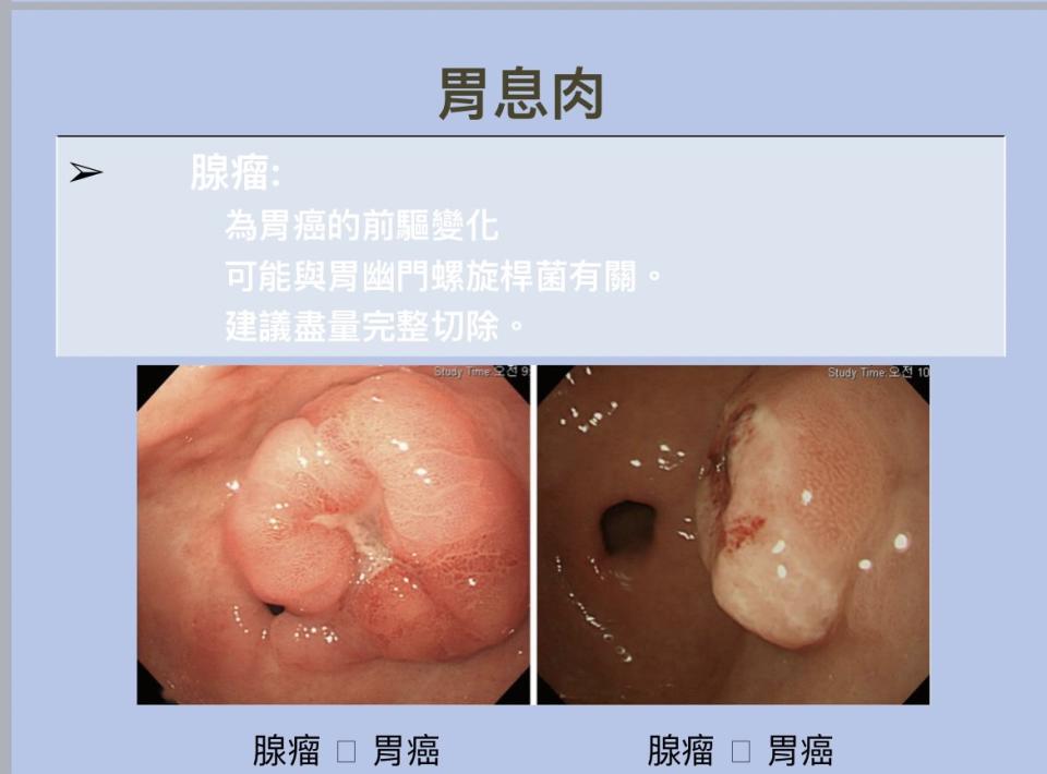 若胃鏡發現有形狀不規則的腺瘤性息肉，就建議盡快切除。（圖：台安醫院蘇志盛醫師提供）