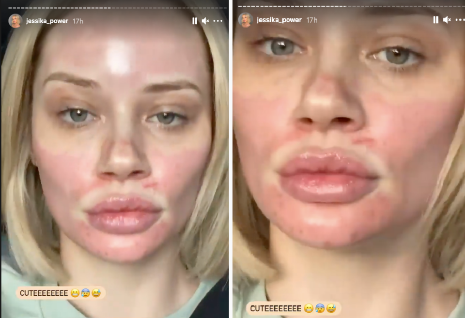 Images of MAFS bride Jessika Power with red, swollen face after vampire facial