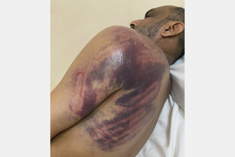 This photo shows Ismail Jussa, an official with Tanzania's opposition ACT Wazalendo party, after what the party alleges was a severe beating by soldiers on election day on Wednesday, Oct. 28, 2020, in Zanzibar. Vote-counting was far from over when Tanzanian opposition leader Seif Sharif Hamad was frustrated enough to call people onto the streets. As thwarted observers alleged the most blatant election fraud in the country's history, and with no way to challenge the results in court, there was little to do but protest. (AP Photo)