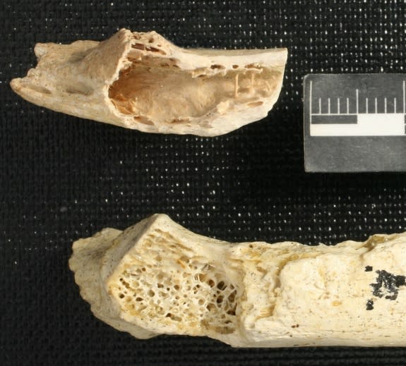 A Neanderthal rib fragment (top) reveals a gaping cavity where weblike spongey bone should be (see healthy rib, bottom). This cavity is evidence of the oldest known human tumor ever found, reported June 5, 2013 in the journal PLOS ONE.