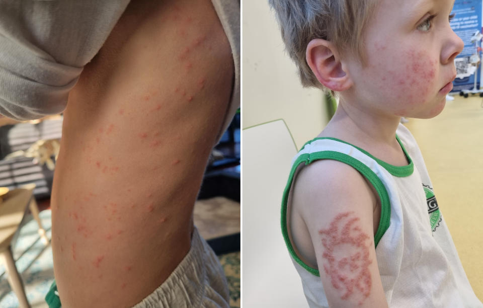 Riley's torso is covered in a red rash, while the outline of the henna tattoo is now a raised, red scabby rash.