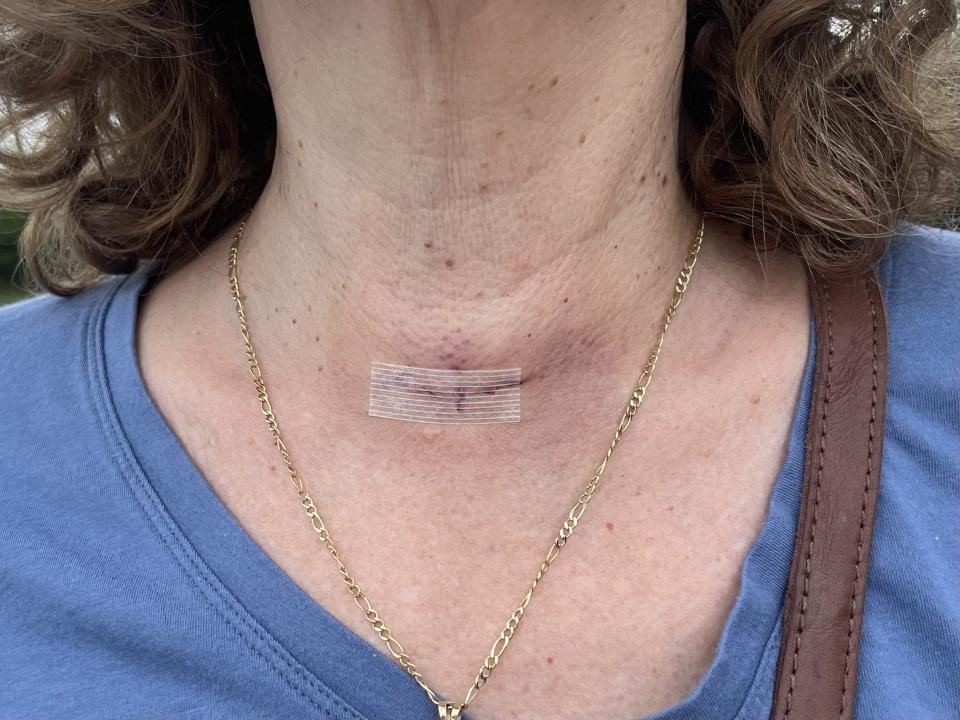 Janet Alessi's surgery removed not one, but two tumors that put her health in peril.