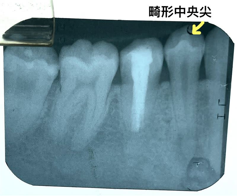 畸形中央尖（圖／北市聯醫提供）