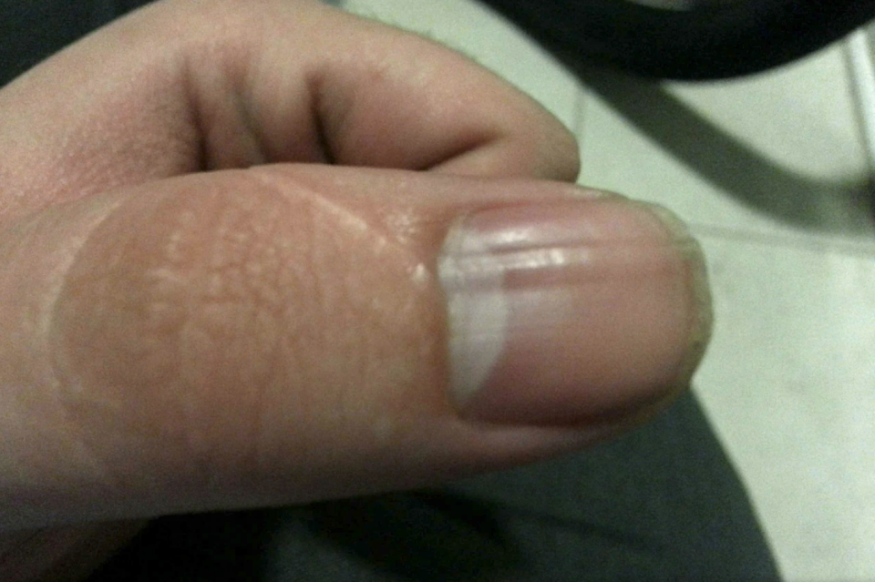 Close-up image of a person's thumb with visible horizontal ridges on the fingernail