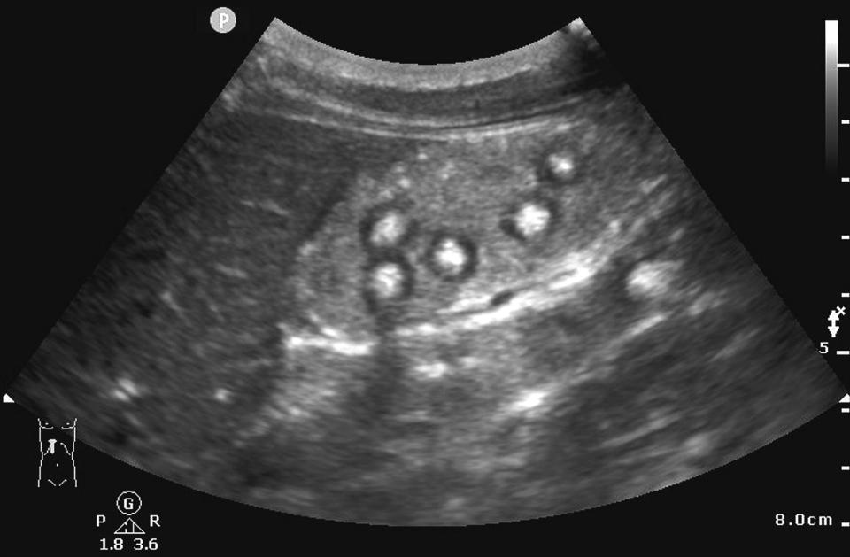 An ultrasound shows tapioca pearls inside a teenage boy's chest cavity.