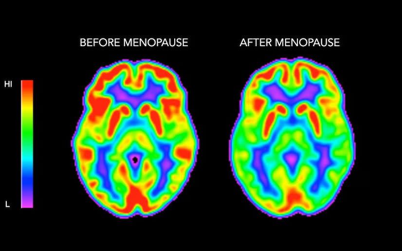 Menopause brain scans