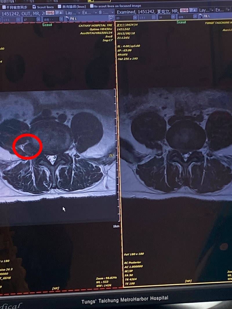 夏克立受椎間盤疾病所苦（圖／夏克立提供）