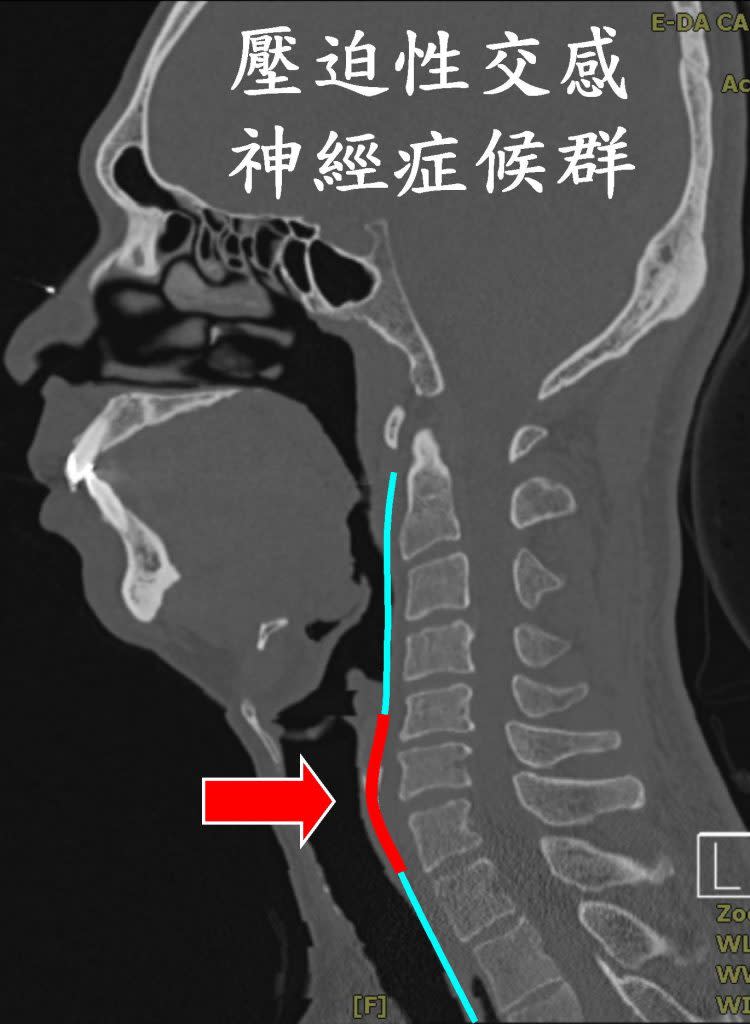 頸椎椎間盤向前突出會向前壓迫交感神經，引起自律神經失調。（陳建志提供）