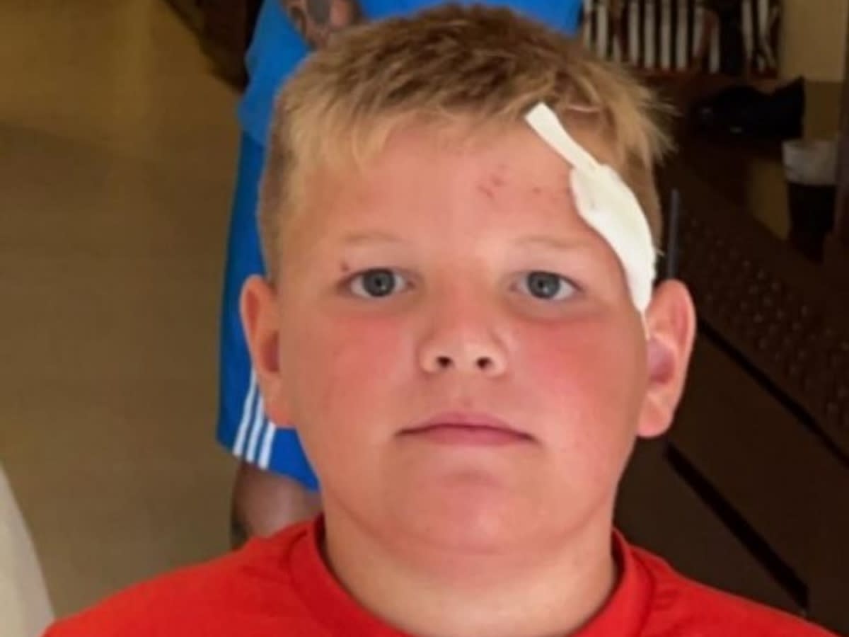 Ollie, 10, accidentally smashed his head through the balcony’s sliding glass door. (Reach)