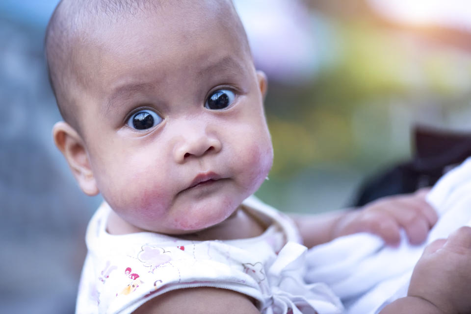 A baby looks at the camera, with reddened patches on her cheeks and flaky dry skin