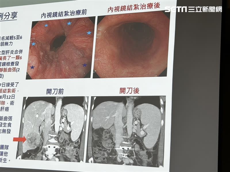 林先生肝臟長了一顆6公分腫瘤，胃鏡檢查發現食道長出6條靜脈曲張（左上圖星星處）。（圖／記者簡浩正攝影）