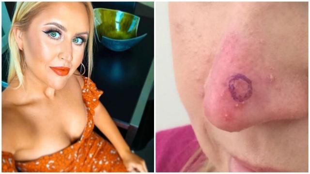 640px x 360px - MAFS' Lauren Huntriss reveals she had skin cancer