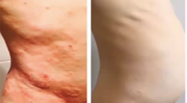 Before and after photo of Tyler. Source: YouTube/Dr Aron Eczema Support.