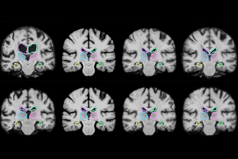 Right now, comparing 3D medical scans is a pain -- it can take two hours or