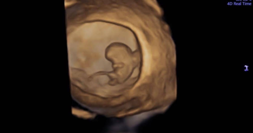 蘇怡寧今（16日）在臉書PO出1張寶寶的超音波照片，只見胎兒身體上有1根凸出物顯得特別長。（圖／翻攝自蘇怡寧醫師愛碎念臉書）