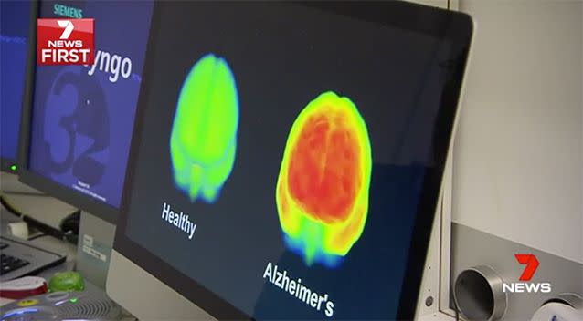 Researchers have made a major breakthrough in Alzheimer's. Source: 7 News