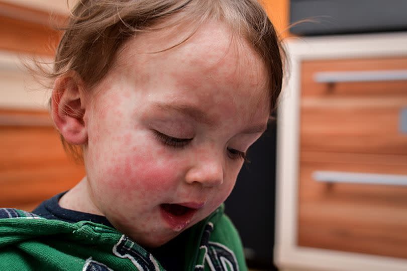 A child with measles