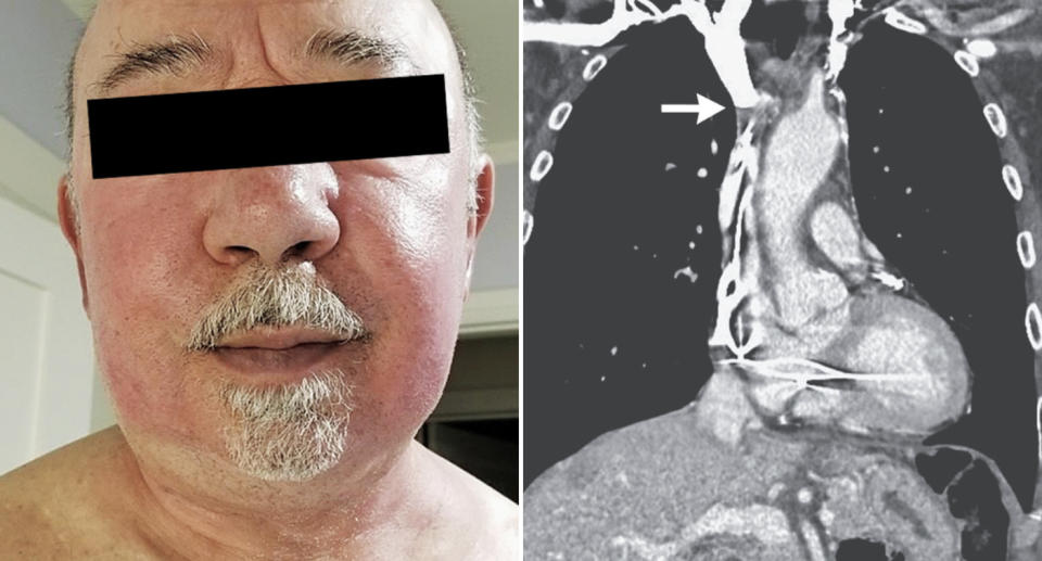 A man's face is pictured, swollen and red. A CT scan is also pictured of his chest which shows his pacemaker wiring caught in blood clots.